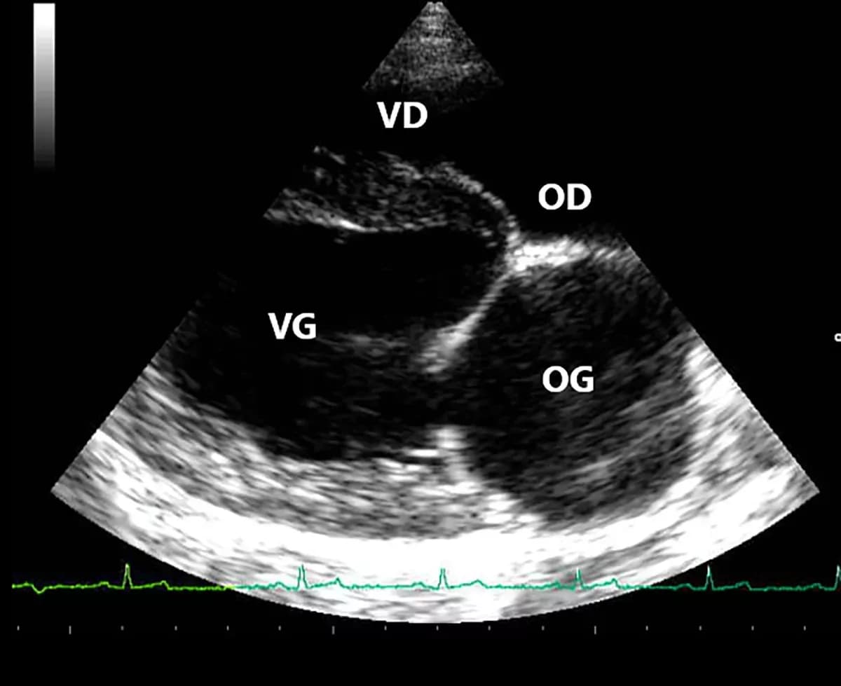 Echocardio